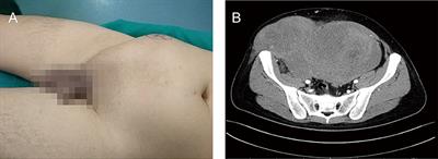 Surgical Management of a Giant Desmoid Fibromatosis of Abdominal Wall With Vessels Invasion in a Young Man: A Case Report and Review of the Literature